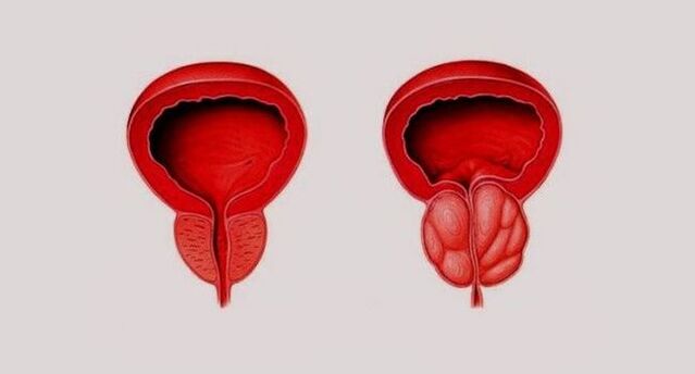 Healthy prostate (left) and inflamed due to prostatitis (right)