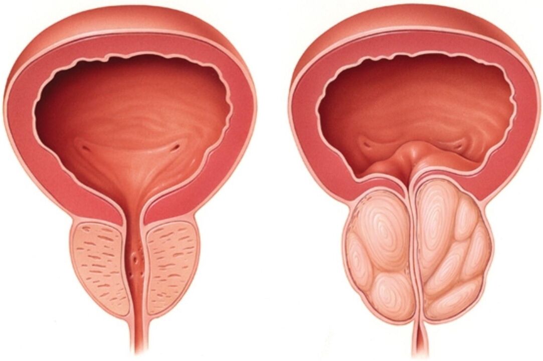 Normal prostate (left) and prostatitis with signs of inflammation (right)