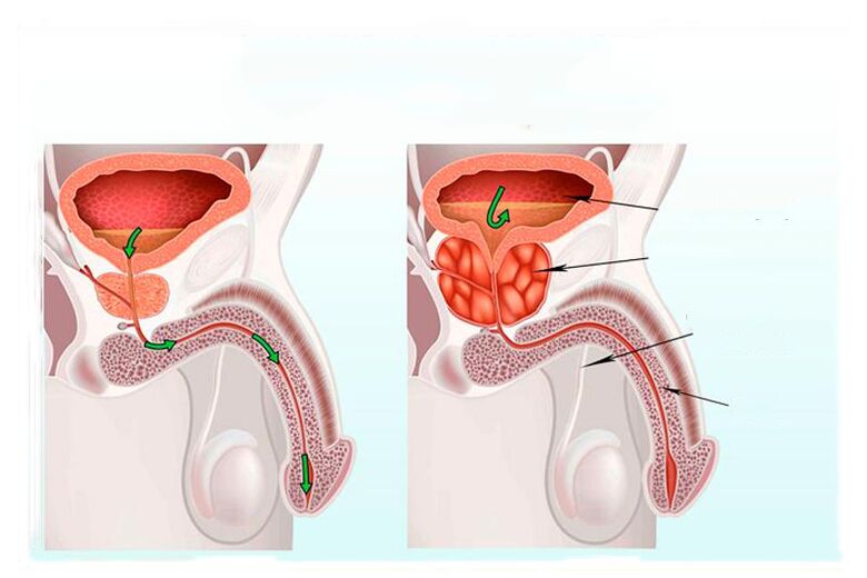 the norm and inflammation of the prostate gland