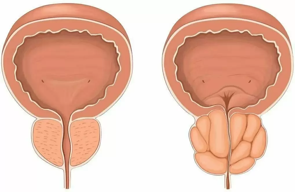 Normal prostate and wound prostate